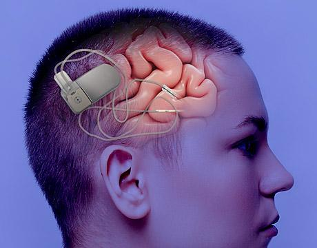 Neurostimulation Market Growth: 11.35% CAGR Drivers & Segmentation
